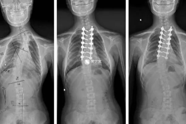 迟发性脊椎骨骼发育不全可以做三代试管