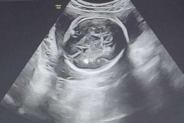 孕16周女宝B超图特征明显
