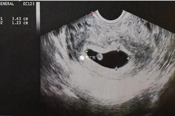 怀8周男孩胎囊图