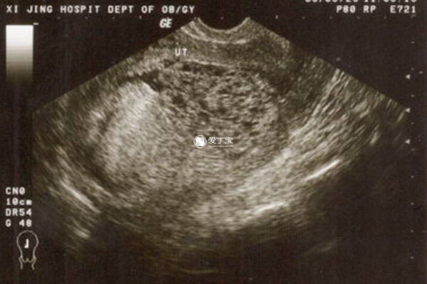 葡萄胎后备孕需要检查肝功能